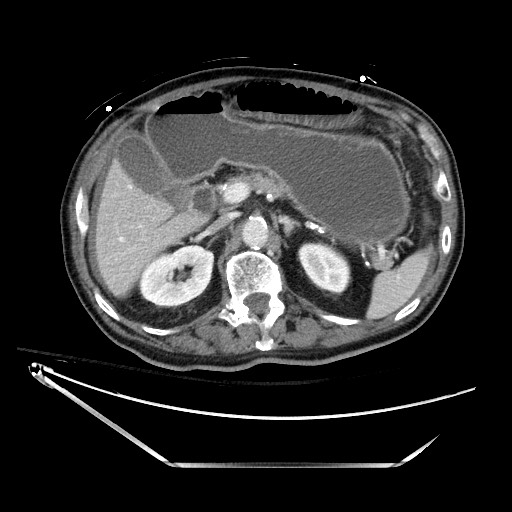 File:Closed loop obstruction due to adhesive band, resulting in small bowel ischemia and resection (Radiopaedia 83835-99023 D 51).jpg