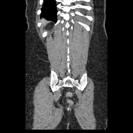 File:Closed loop small bowel obstruction (Radiopaedia 65403-74451 B 89).jpg