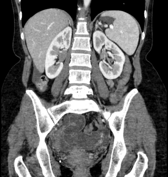 Closed loop small bowel obstruction (Radiopaedia 71211-81508 B 82).jpg