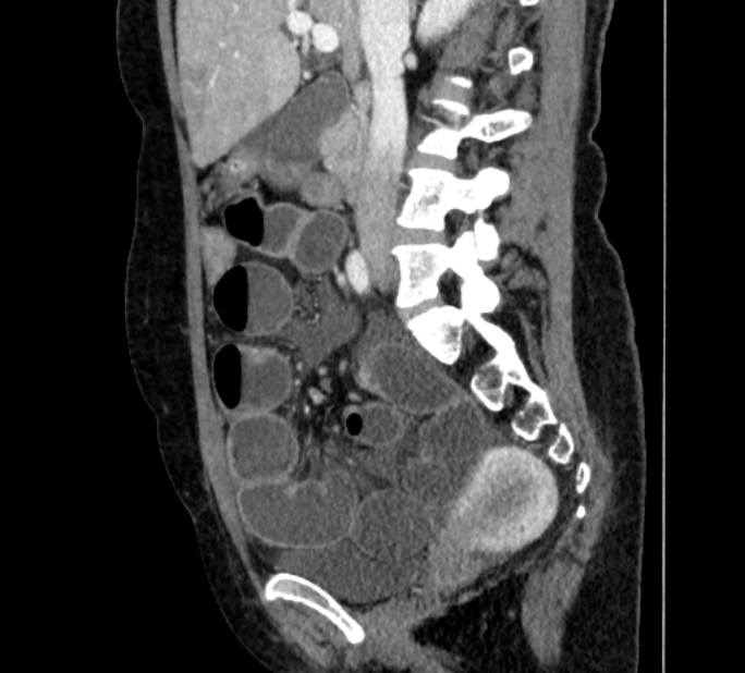 Closed loop small bowel obstruction (Radiopaedia 71211-81508 C 59).jpg