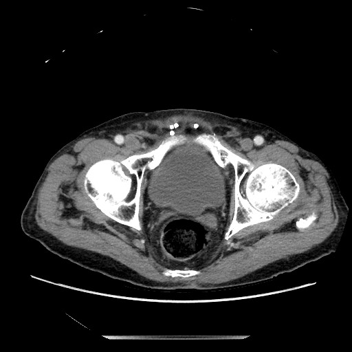 Closed loop small bowel obstruction - adhesive disease and hemorrhagic ischemia (Radiopaedia 86831-102990 A 166).jpg