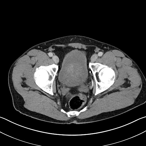 Closed loop small bowel obstruction - internal hernia (Radiopaedia 57806-64778 B 117).jpg