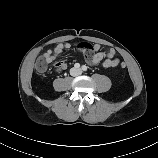 File:Closed loop small bowel obstruction - internal hernia (Radiopaedia 57806-64778 B 75).jpg