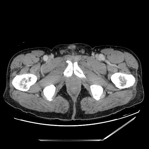 Closed loop small bowel obstruction - omental adhesion causing "internal hernia" (Radiopaedia 85129-100682 A 179).jpg