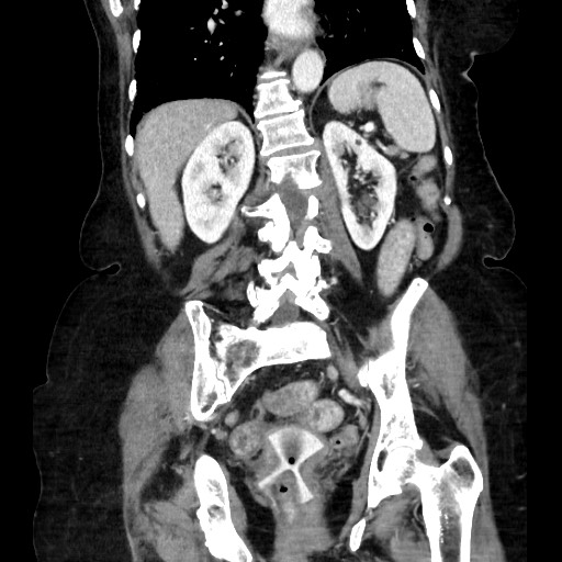 Closed loop small bowel obstruction due to adhesive band, with intramural hemorrhage and ischemia (Radiopaedia 83831-99017 C 84).jpg