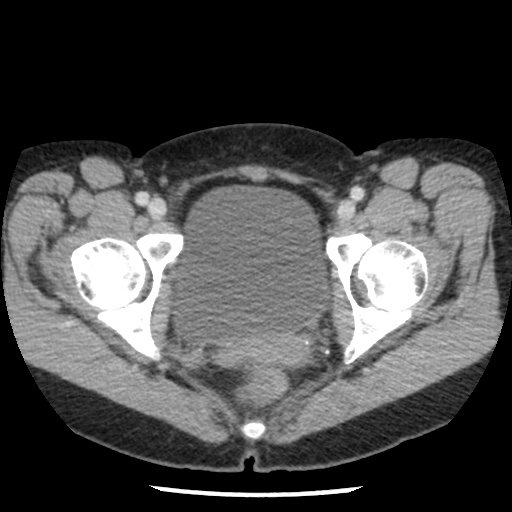 File:Closed loop small bowel obstruction due to trans-omental herniation (Radiopaedia 35593-37109 A 82).jpg