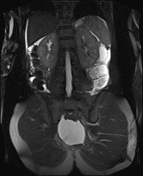 File:Closed loop small bowel obstruction in pregnancy (MRI) (Radiopaedia 87637-104031 Coronal T2 fat sat 41).jpg