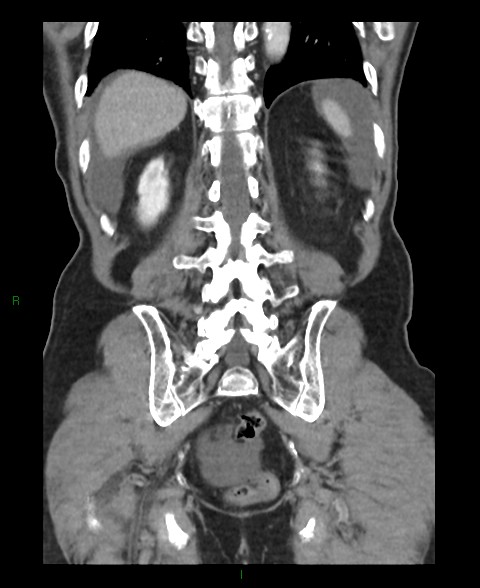 Closed loop small bowel obstruction with ischemia (Radiopaedia 84180-99456 B 13).jpg