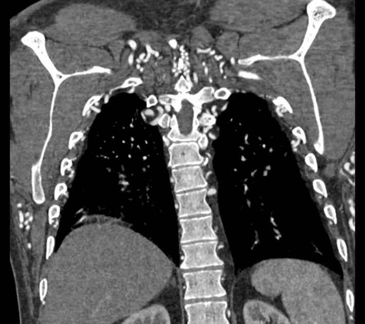 Coarctation of the aorta (Radiopaedia 53752-59822 B 63).jpg
