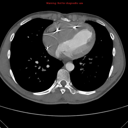 File:Coarctation of the aorta (Radiopaedia 9434-10118 A 128).jpg