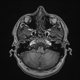 File:Cochlear incomplete partition type III associated with hypothalamic hamartoma (Radiopaedia 88756-105498 Axial T1 53).jpg