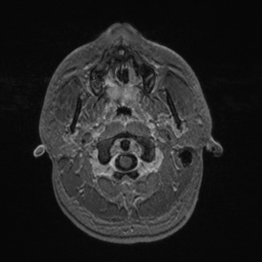 Colloid cyst (Radiopaedia 44510-48181 Axial T1 C+ 19).png