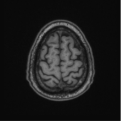 File:Colloid cyst of the third ventricle (Radiopaedia 86571-102662 Axial T1 67).png
