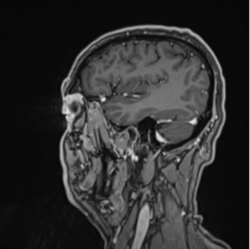 File:Colloid cyst of the third ventricle (Radiopaedia 86571-102662 Sagittal T1 C+ 61).png
