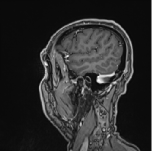 File:Colloid cyst of the third ventricle (Radiopaedia 86571-102662 Sagittal T1 C+ 65).png