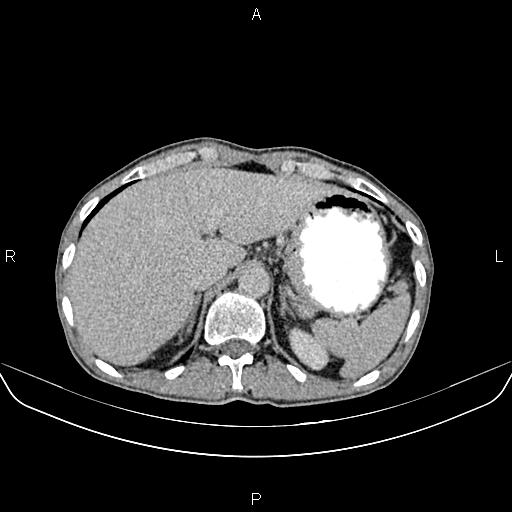 File:Colon adenocarcinoma - hepatic flexure (Radiopaedia 85635-101395 Axial C+ delayed 18).jpg
