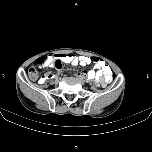 File:Colon adenocarcinoma - hepatic flexure (Radiopaedia 85635-101395 Axial C+ delayed 67).jpg