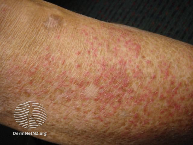File:Eczema craquelé (DermNet NZ dermatitis-eczema-craquele2).jpg