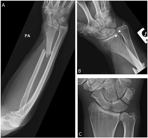 File:Galeazzi fracture1.png