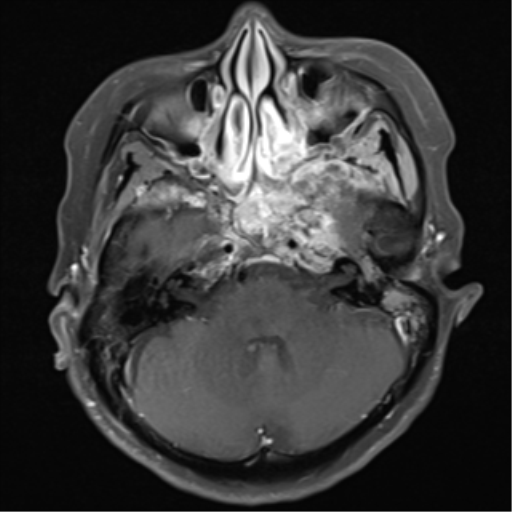 File:Nasopharyngeal carcinoma with cerebral abscess (Radiopaedia 43018-46273 Axial T1 C+ fat sat 14).png