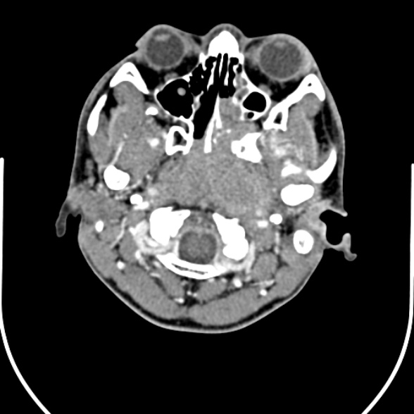 Nasopharyngeal carcinoma with skull base invasion (Radiopaedia 53415-59705 A 35).jpg