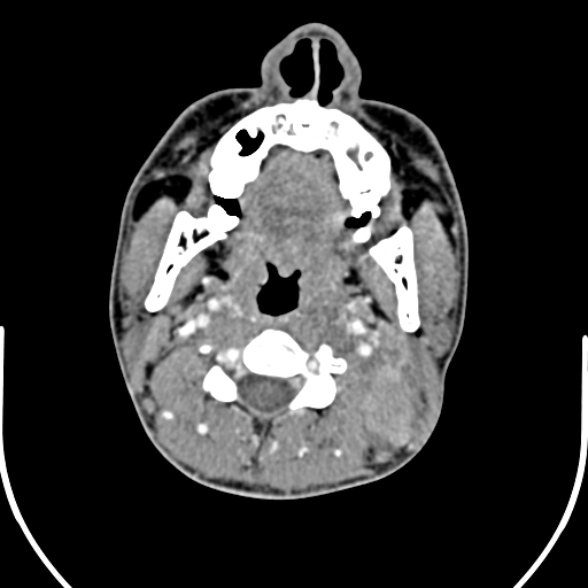 File:Nasopharyngeal carcinoma with skull base invasion (Radiopaedia 53415-59705 A 89).jpg