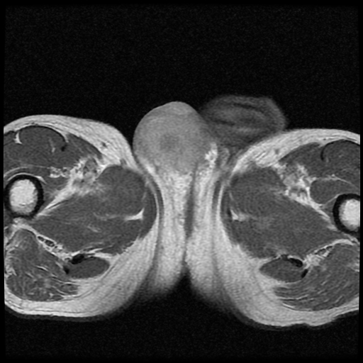 File:Necrotizing epididymo-orchitis with intra-testicular abscess (Radiopaedia 29397-29860 Axial T1 C+ 12).jpg