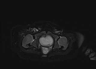 Neonatal prostatic utricle abscess - cyst (Radiopaedia 69511-79394 Axial T2 fat sat 13).jpg