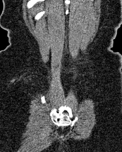 File:Nephrostomy for urosepsis (Radiopaedia 26180-26330 non-contrast 80).jpg