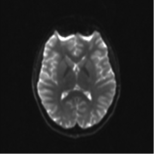 Neurenteric cyst (Radiopaedia 58641-65837 Axial DWI 20).png