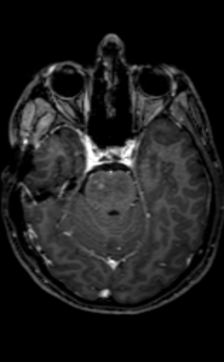 Neuro-Behçet disease (Radiopaedia 90112-107294 Axial T1 C+ 156).jpg