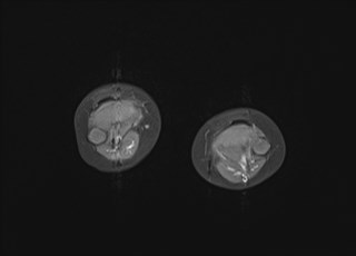 File:Neuroblastoma with bone metastases (Radiopaedia 67080-76414 Axial T1 C+ fat sat 2).jpg
