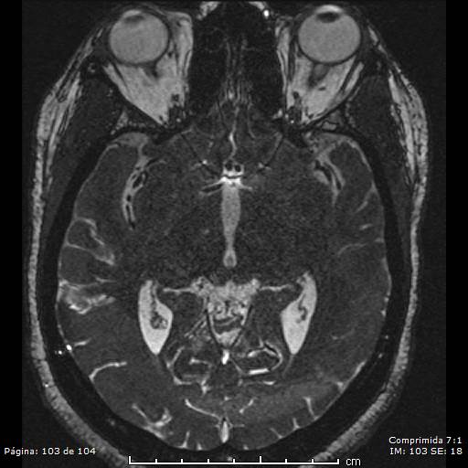 Neurocysticercosis (Radiopaedia 58636-65832 I 103).jpg
