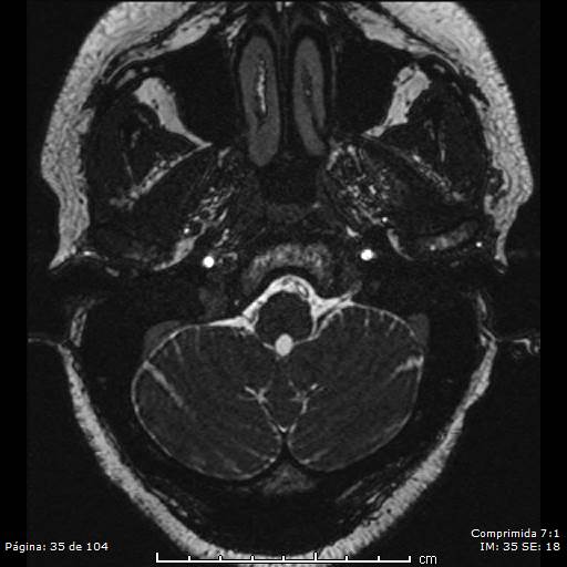 Neurocysticercosis (Radiopaedia 58636-65832 I 35).jpg