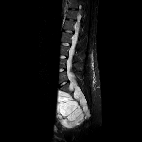 File:Neurofibromatosis type 1- extensive spinal involvement and Christmas tree sign (Radiopaedia 60610-68332 Sagittal STIR 5).jpg