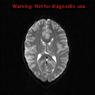 File:Neurofibromatosis type 1 with optic nerve glioma (Radiopaedia 16288-15965 Axial DWI 10).jpg