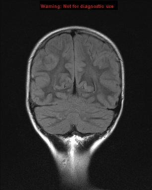 File:Neurofibromatosis type 1 with optic nerve glioma (Radiopaedia 16288-15965 Coronal FLAIR 6).jpg