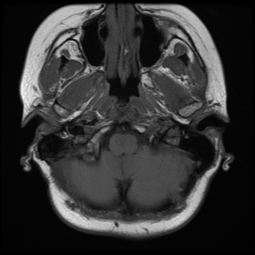 File:Neurofibromatosis type 2 (Radiopaedia 45229-49251 Axial T1 7).png