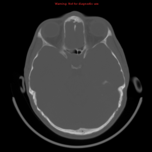 File:Neurofibromatosis type 2 (Radiopaedia 8953-9732 Axial bone window 12).jpg