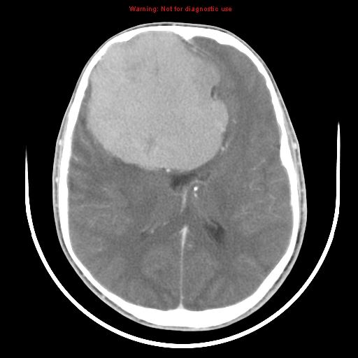 File:Neurofibromatosis type 2 (Radiopaedia 8953-9732 C 20).jpg