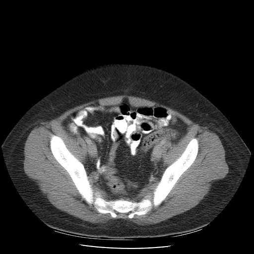 File:Non-Hodgkin lymphoma involving pelvis (Radiopaedia 21281-21197 A 51).jpg