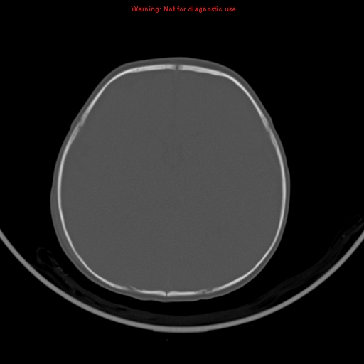 File:Non-accidental injury - bilateral subdural with acute blood (Radiopaedia 10236-10765 Axial bone window 13).jpg