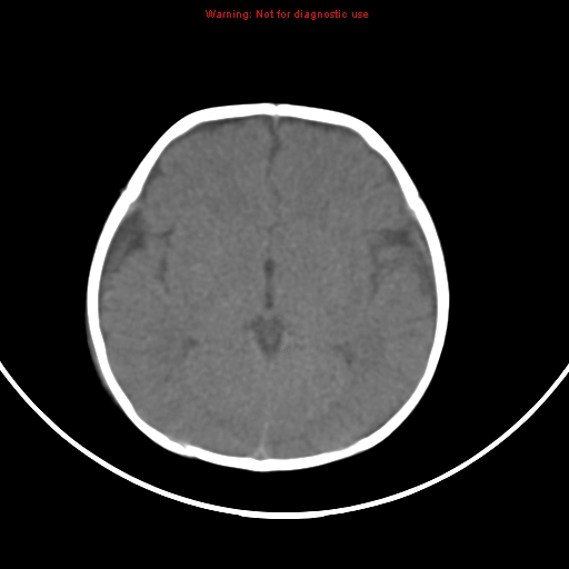 File:Non-accidental injury - bilateral subdural with acute blood (Radiopaedia 10236-10765 Axial non-contrast 11).jpg