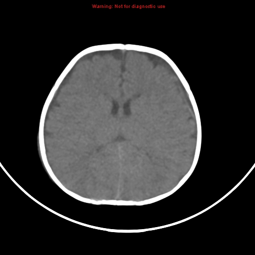File:Non-accidental injury - bilateral subdural with acute blood (Radiopaedia 10236-10765 Axial non-contrast 13).jpg