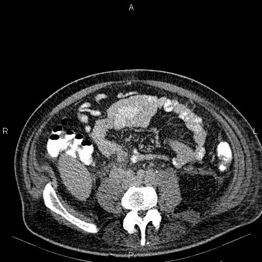 Non Hodgkin lymphoma in a patient with ankylosing spondylitis (Radiopaedia 84323-99621 Axial C+ delayed 46).jpg