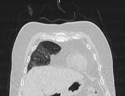 Non specific interstitial pneumonia (NSIP) (Radiopaedia 89725-106798 Coronal lung window 14).jpg