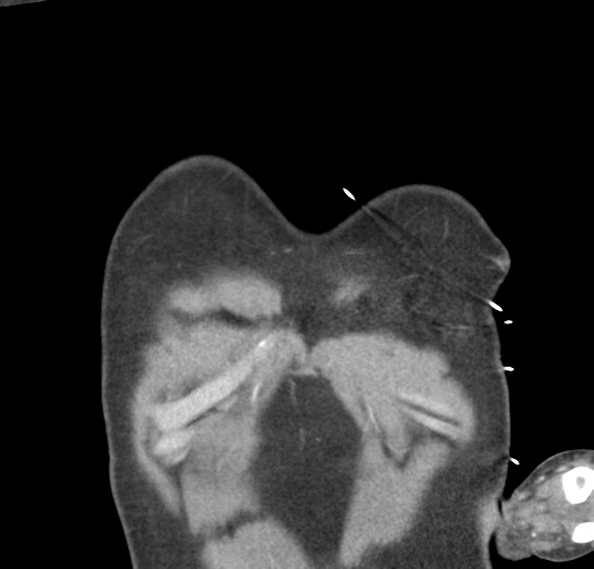 File:Normal CTA thorax (non ECG gated) (Radiopaedia 41750-44704 B 9).png