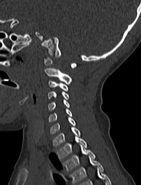 Normal CT cervical spine - pediatric (Radiopaedia 52549-58462 Sagittal bone window 62).jpg