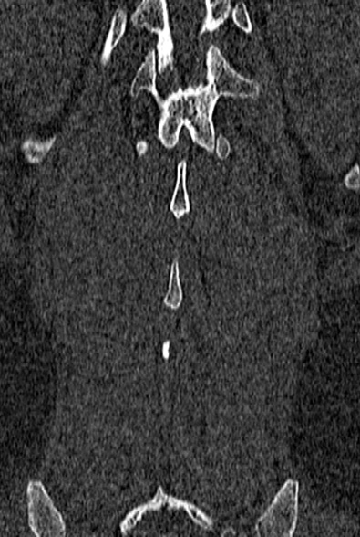 Normal CT lumbar spine (Radiopaedia 53981-60118 Coronal bone window 62).jpg