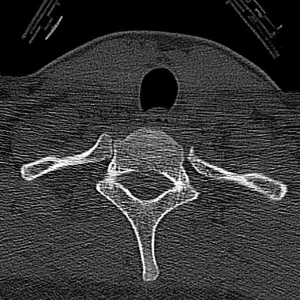 Normal CT of the cervical spine (Radiopaedia 53322-59305 Axial bone window 232).jpg